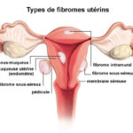 Quel traitement des fibromes, kystes et myomes ?