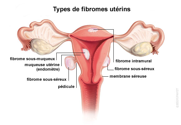You are currently viewing Quel traitement des fibromes, kystes et myomes ?